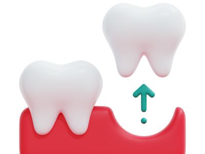 Wisdom Tooth Extraction New Westminster