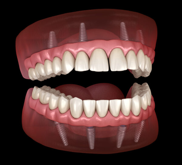Full mouth dental implants new westminster