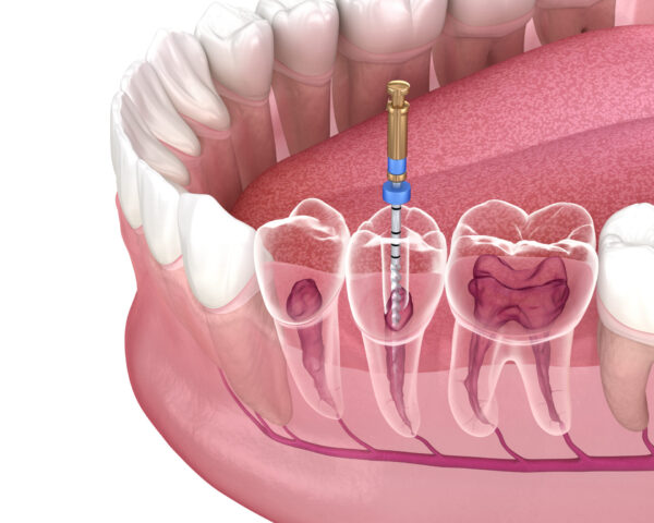 Root canal in New Westminster
