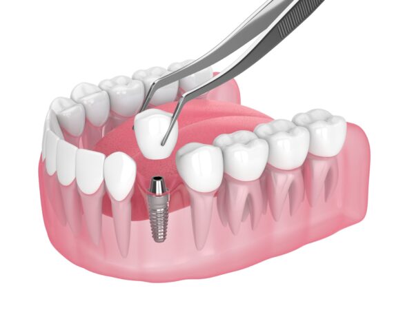 dental implants New Westminster