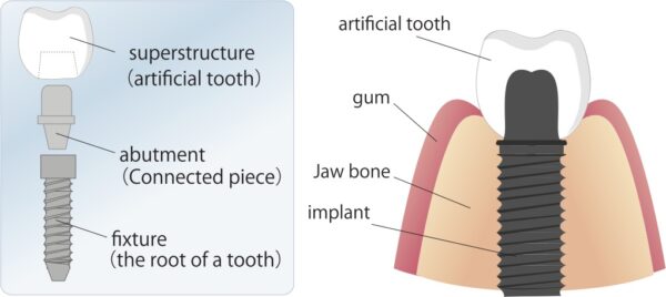 complete dental implants